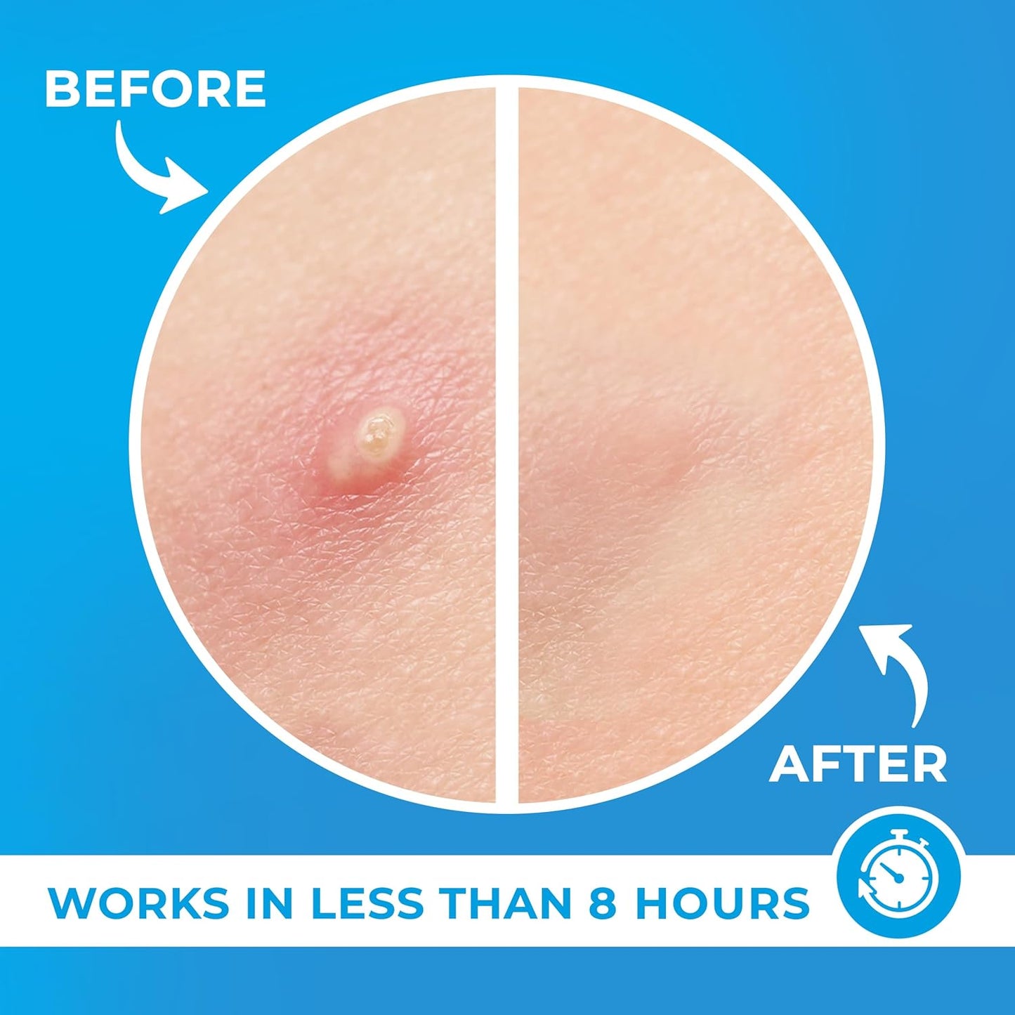 Transform Your Skin with Our Hydrocolloid Acne Patches - 240 Effective Pimple Stickers Infused with Tea Tree Oil for Rapid Blemish Relief