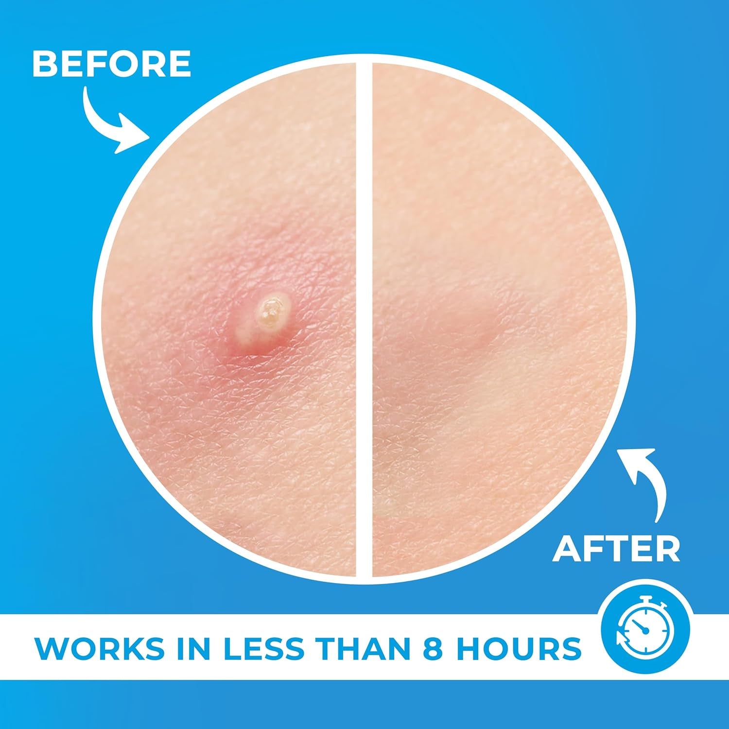 Transform Your Skin with Our Hydrocolloid Acne Patches - 240 Effective Pimple Stickers Infused with Tea Tree Oil for Rapid Blemish Relief